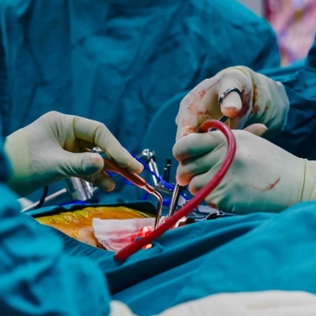 Cirugía pancreática: la mortalidad operatoria en muchos hospitales es demasiado alta