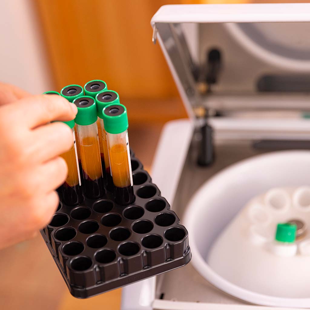 Stem cells infiltrations to treat osteoarthritis