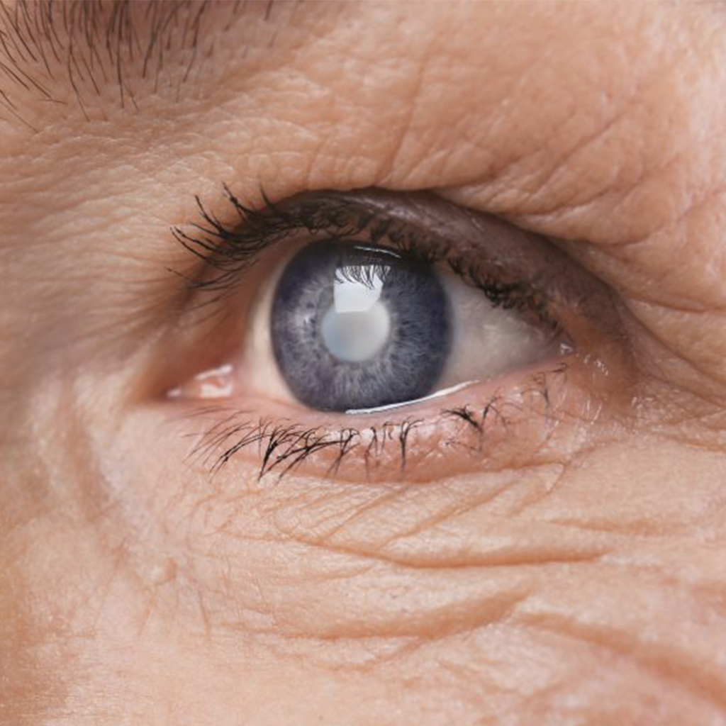 Cataract surgery with intraocular lenses to correct vision defects
