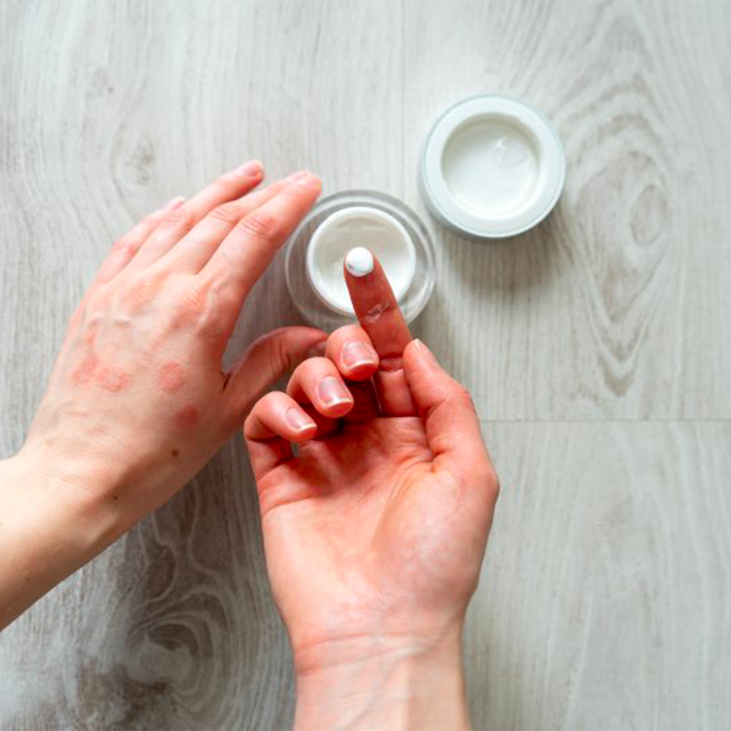 Pustular psoriasis: symptoms, causes and remedies