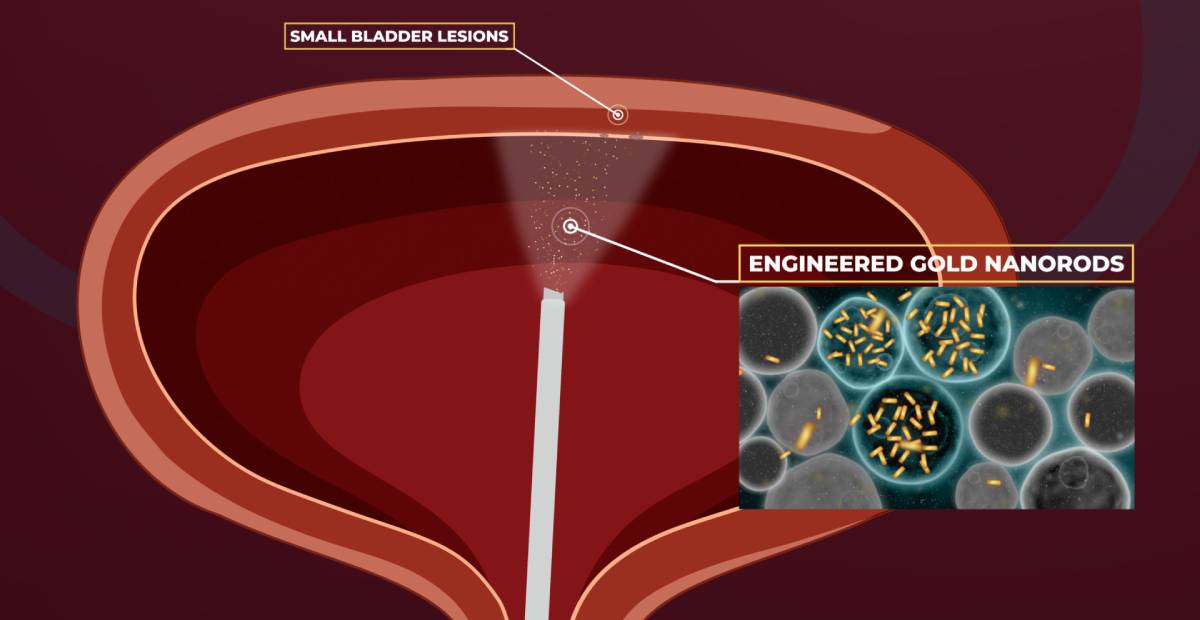 Gold Nanoparticles: San Raffaele's Research Opens New Frontiers in Detecting and Eliminating Previously Invisible Bladder Tumors
