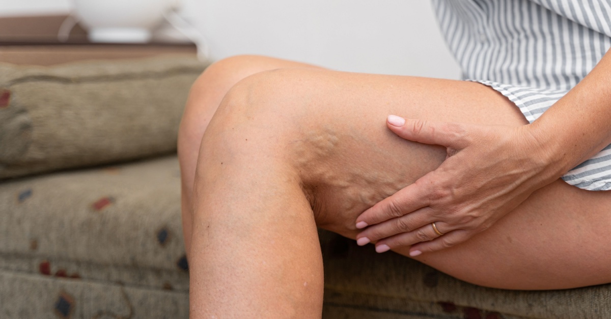 Saphenectomy: Procedure, Recovery, and Rehabilitation