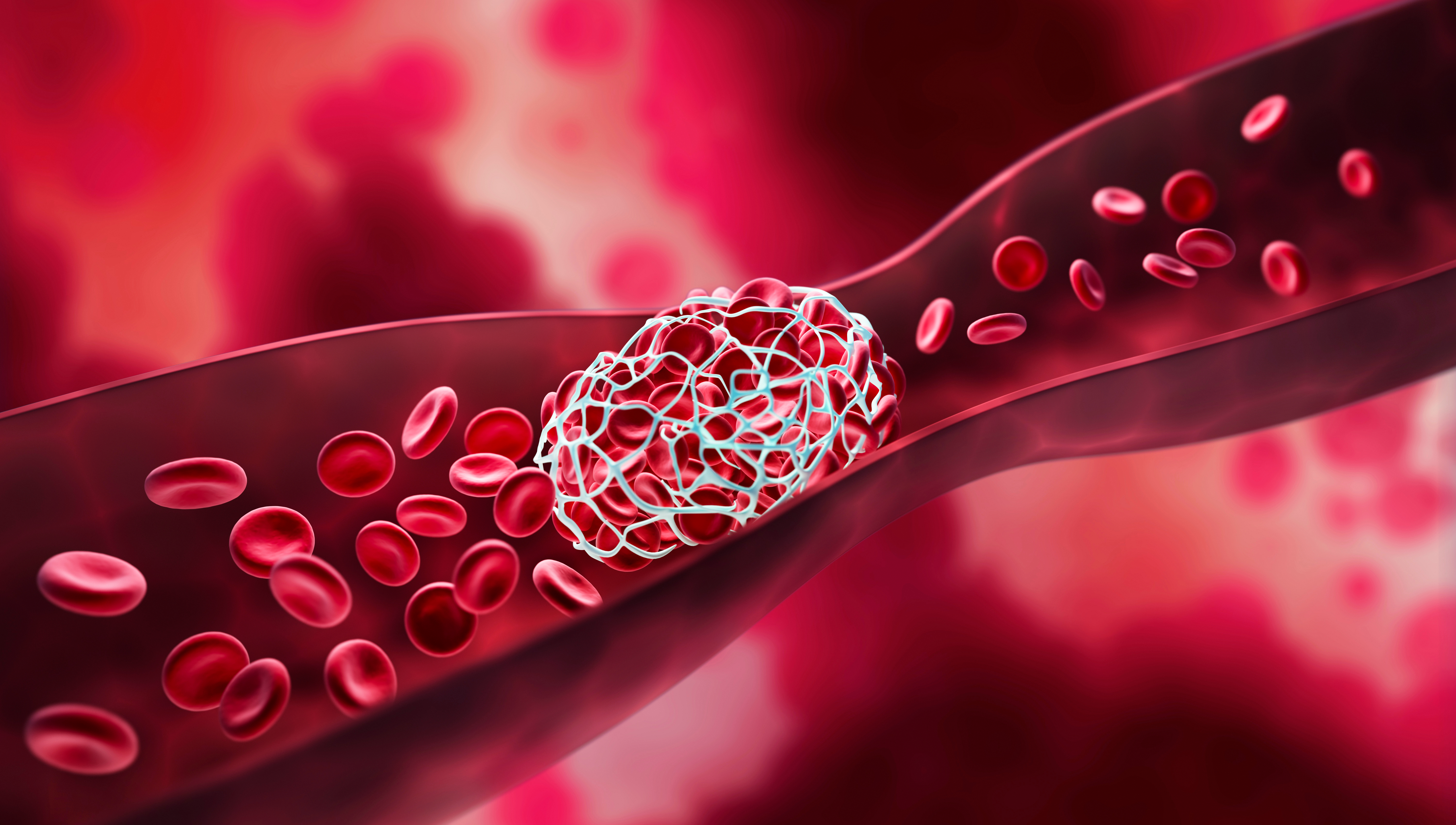 What is thrombophilia and why it is important not to neglect it